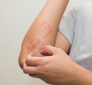 Dermatitis on arm