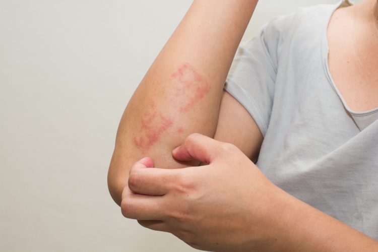 Dermatitis on arm