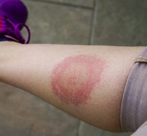 Typical lyme rash on leg