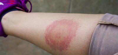 Typical lyme rash on leg