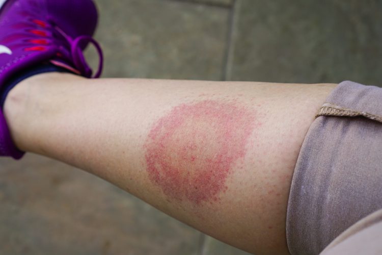 Typical lyme rash on leg