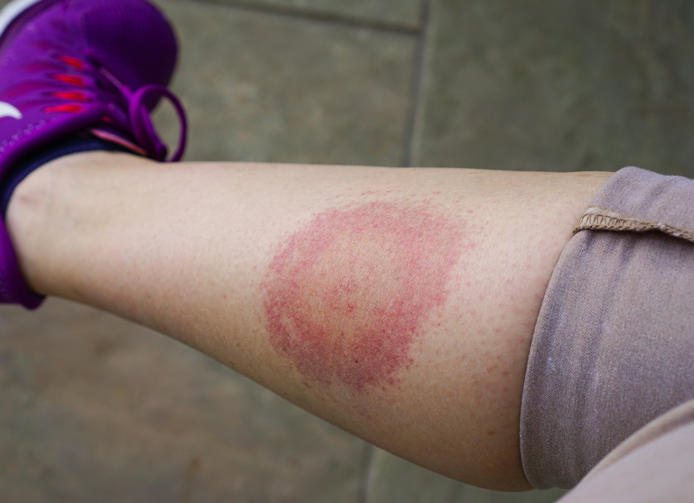 Typical lyme rash on leg