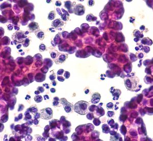 Pleural fluid cytology of lung (pulmonary) papillary adenocarcinoma