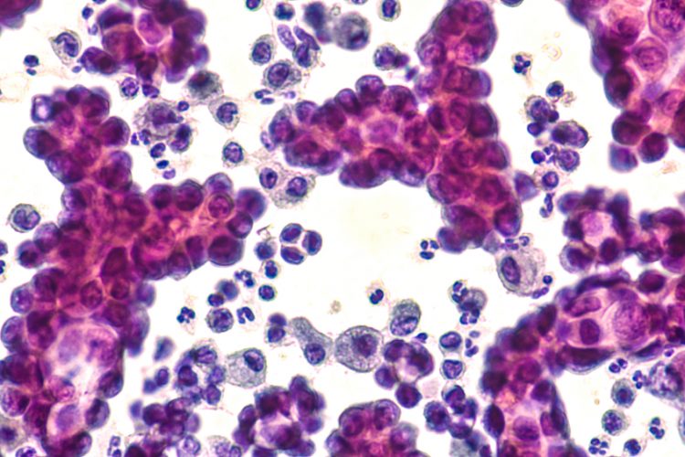 Pleural fluid cytology of lung (pulmonary) papillary adenocarcinoma