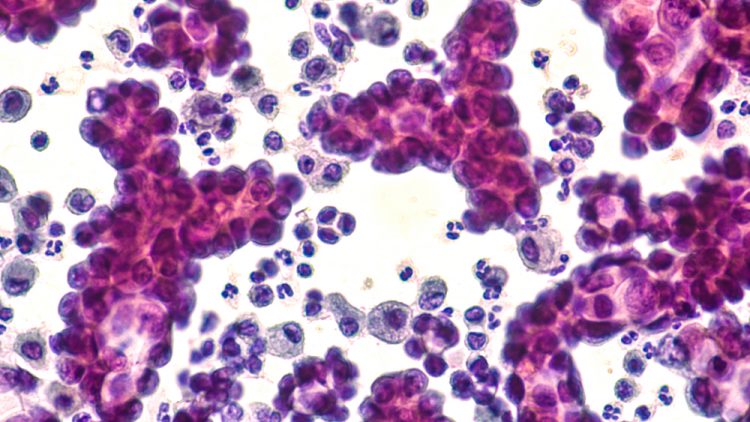 Pleural fluid cytology of lung (pulmonary) papillary adenocarcinoma