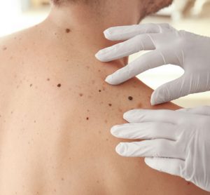 Rare melanoma type highly responsive to immunotherapy