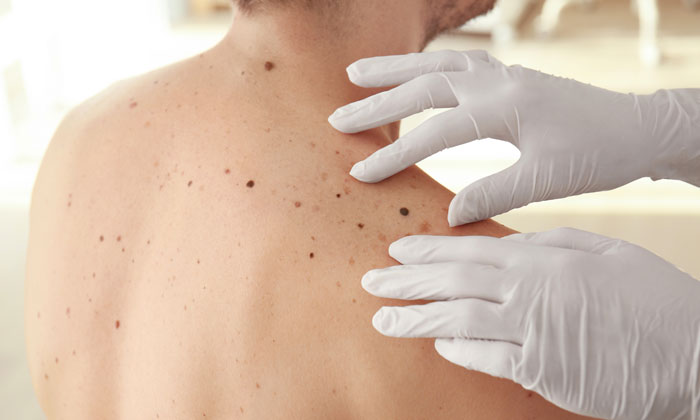 Rare melanoma type highly responsive to immunotherapy