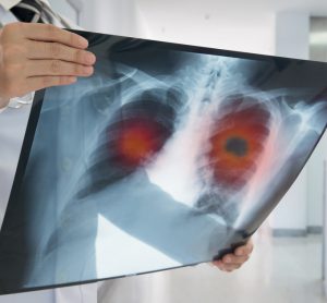 Doctor looking at lung scan with tumour