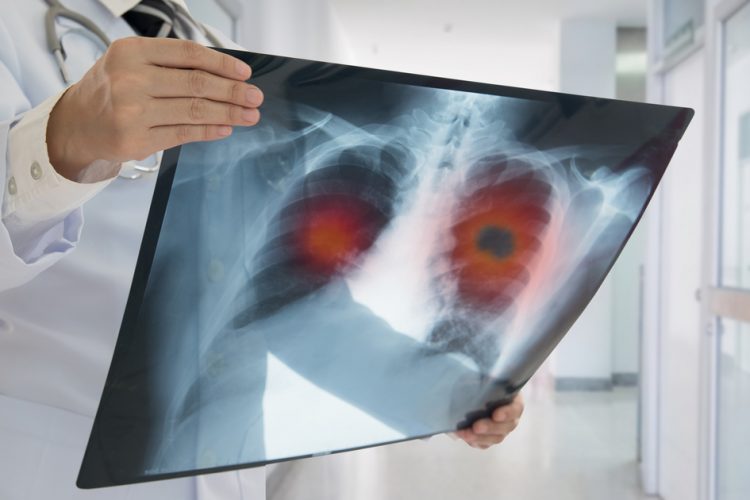 Doctor looking at lung scan with tumour