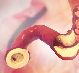 Nilendo as hypercholesterolaemia treatment