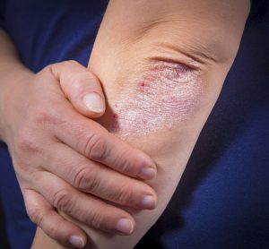 risankizumab for psoriasis