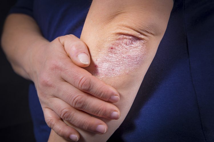 risankizumab for psoriasis