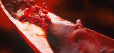 cardiovascular disease LDL cholesterol