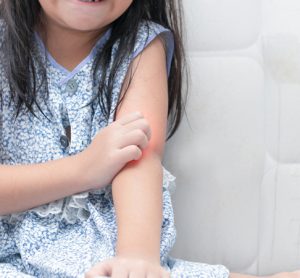 Young girl with red irritated arm