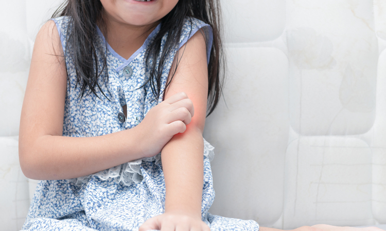 Young girl with red irritated arm