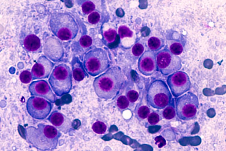 Multiple myeloma microscopic view