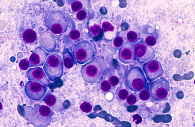 Multiple myeloma microscopic view