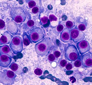 Microscopic image of multiple myeloma