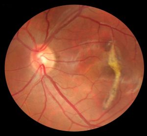 macular degeneration