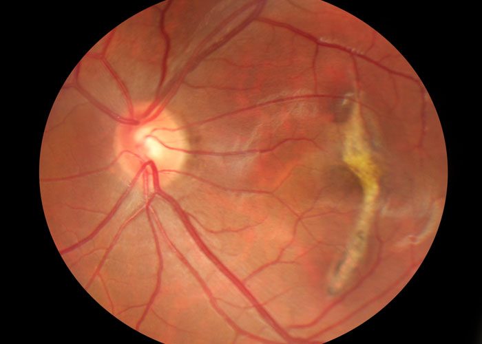 macular degeneration