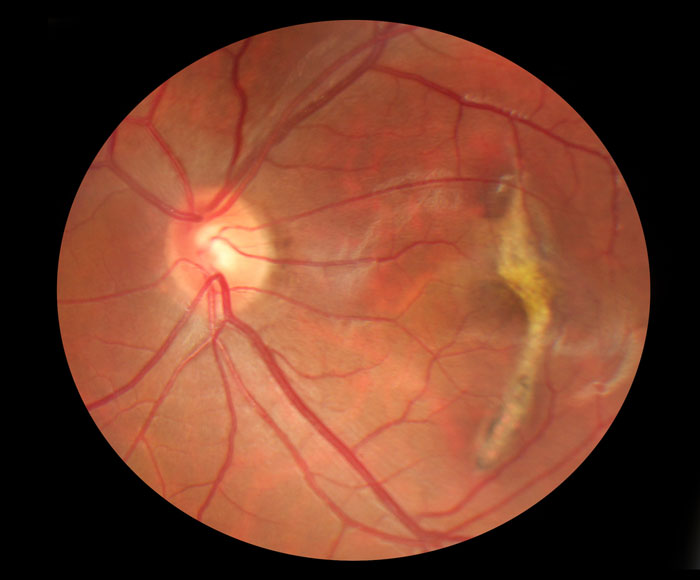 macular degeneration