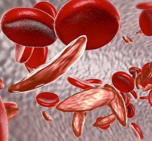 3D illustration of sickled and normal red blood cells in a blood vessel