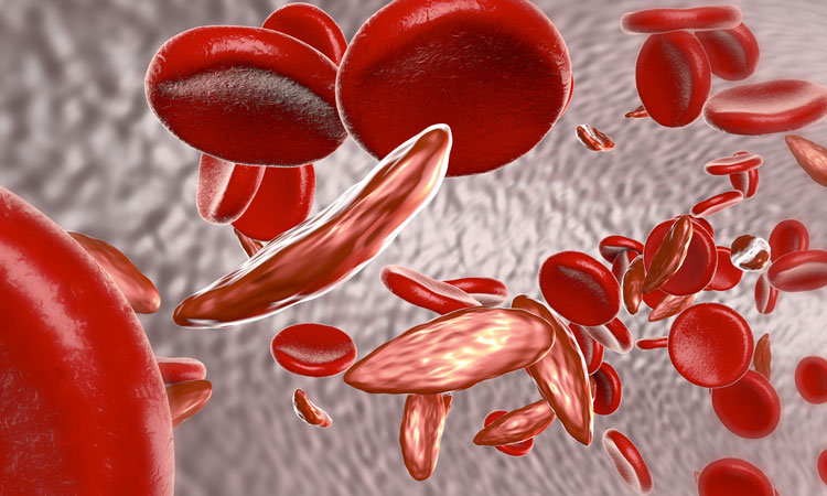 3D illustration of sickled and normal red blood cells in a blood vessel