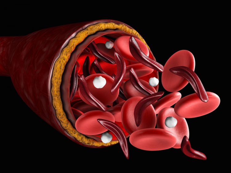 3D illustration of sickle and normal red blood cells coming out of a cut blood vessel - idea of sickle cell disease