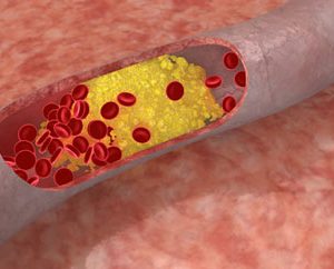 six Phase 3 ODYSSEY trials that showed alirocumab significantly reduced low-density lipoprotein cholesterol