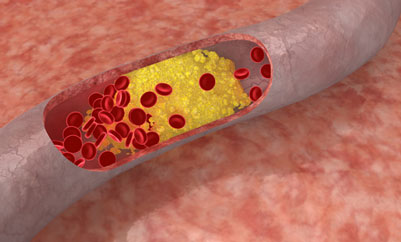 six Phase 3 ODYSSEY trials that showed alirocumab significantly reduced low-density lipoprotein cholesterol