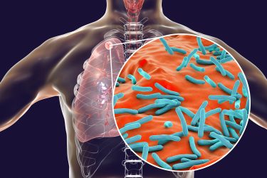cutaway of bacteria eg, tuberculosis in the lungs