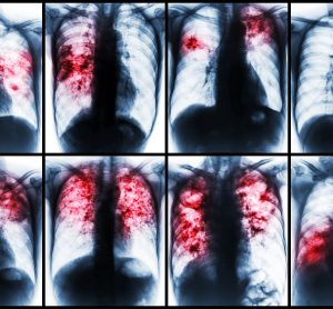 a collection of different tuberculosis patients chest x-rays
