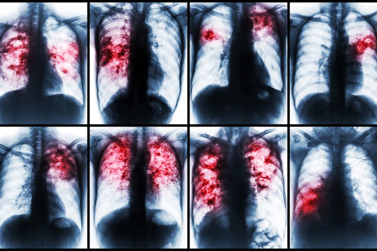 a collection of different tuberculosis patients chest x-rays