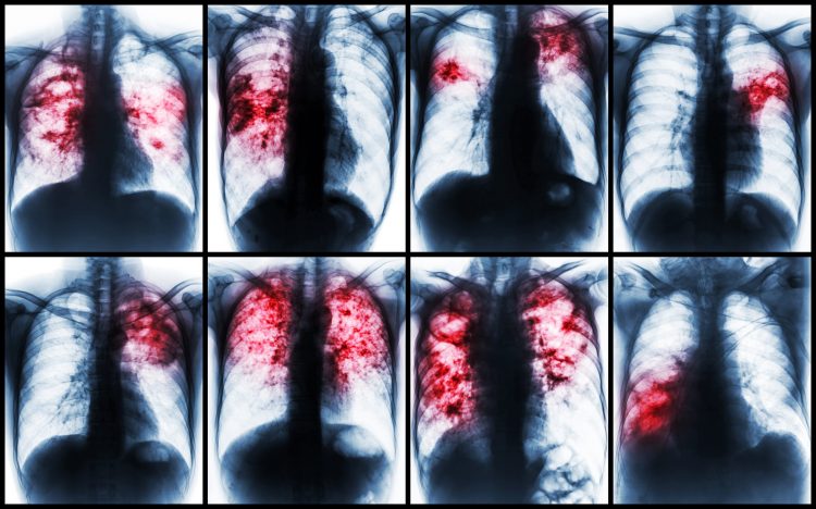 a collection of different tuberculosis patients chest x-rays