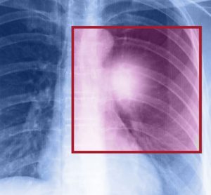 two-drug-combination-lung-cancer