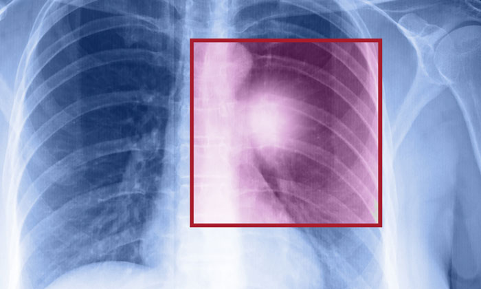 two-drug-combination-lung-cancer