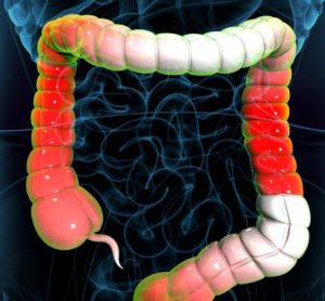 Takeda ulcerative colitis biologic receives FDA approval