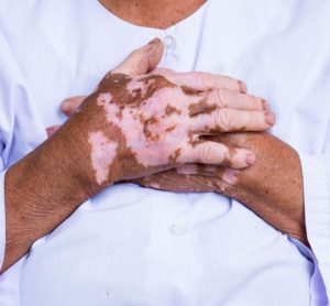 Vitiligo treatment gets positive CHMP opinion