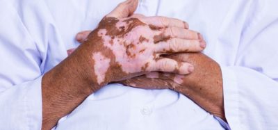 Vitiligo treatment gets positive CHMP opinion