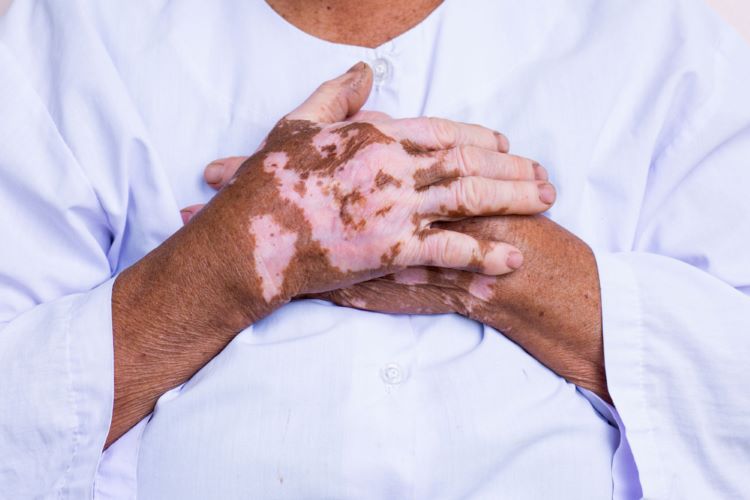 Vitiligo treatment gets positive CHMP opinion