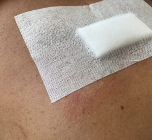 wound healing